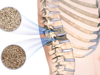 CBD bei Osteoporose für die Gesunderhaltung der Knochen